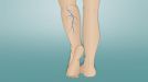 Физическая нагрузка при варикозная сетка на ногах